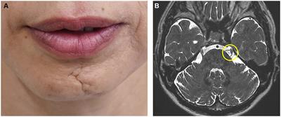 Hemimasticatory spasm: a series of 17 cases and a comprehensive review of the literature